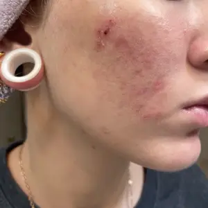 Product Review of Lion Pair Acne Cream Acne Treatment Pimples Removal Cream Pair Acne Creamy Foam Facial Wash Gentle Antibacterial from 𝕒**𝕒