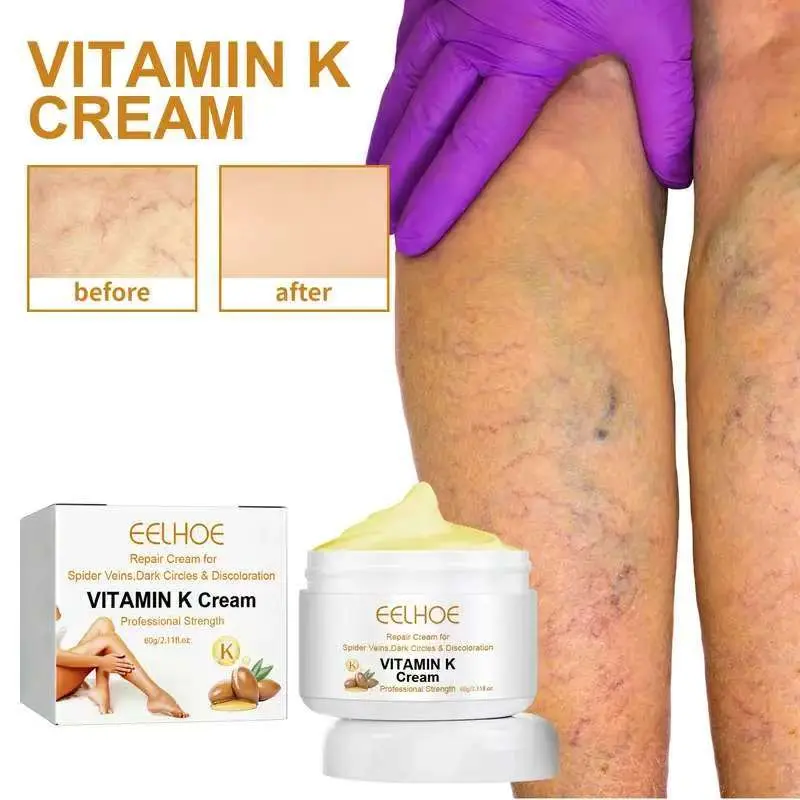 Buy 1 Get 1 Free] Vitamin K Cream, 60g /2.11ozCirculheal VaricoseVeins Cream, Varicose Vein Cream.Remove Varicose.Veinsbody carelotions comfort cosmetic, skin repairskin care