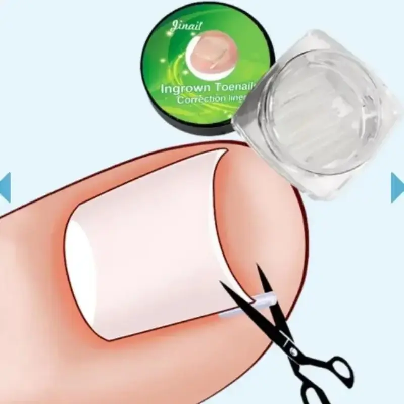 Ultra-Thin Ingrown Nail Corrector Tool Plastic C-Shaped Tube Pad, Nail Growth Correction, Toenail Fungus Treatment, Foot Care Recovery