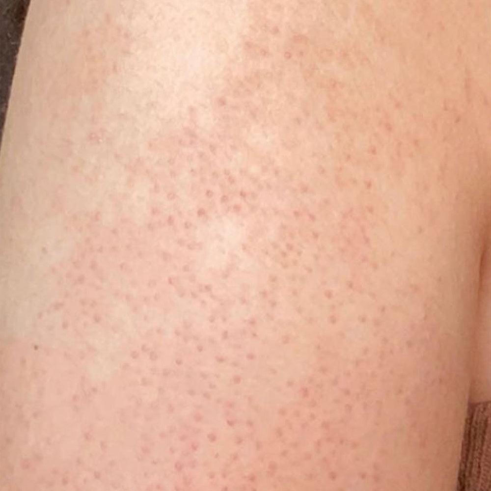 KP Bump Eraser Body Scrub 10% AHA Fresh Strawberry KP Bump Eraser Body Scrub 10% AHA Fresh Strawberry