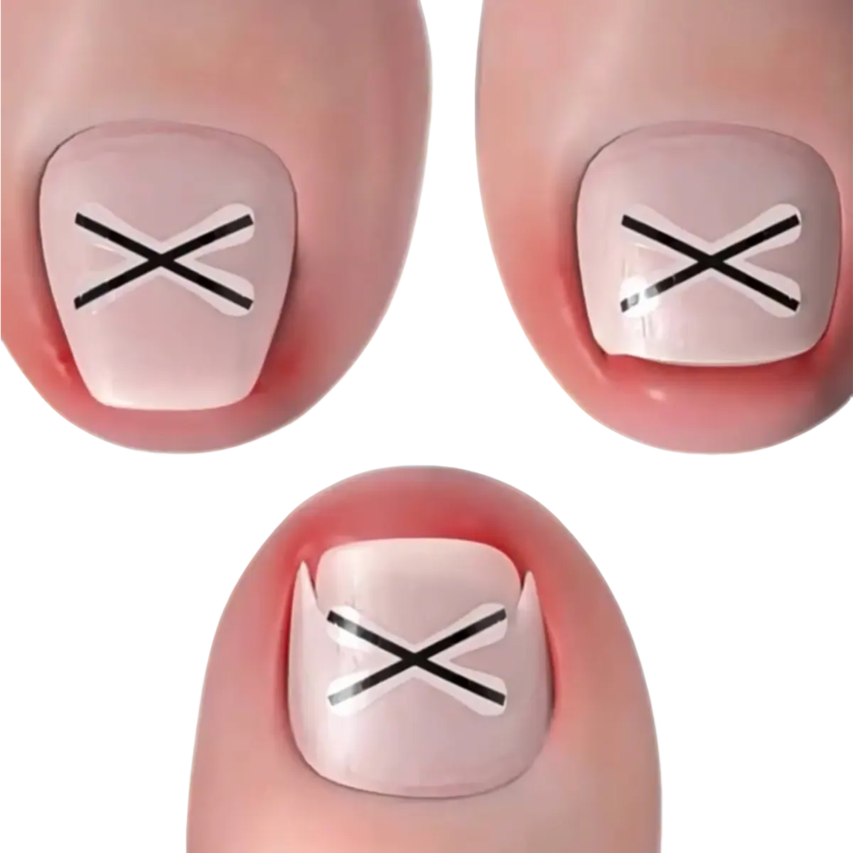 Ingrown Toenail Corrector at Home Ingrown Toenail Remove Curved Toenail Straightener  Cutics Manicure Kit with Quick-Stick Strips for Easy Use and Hygiene nail Patented Technology