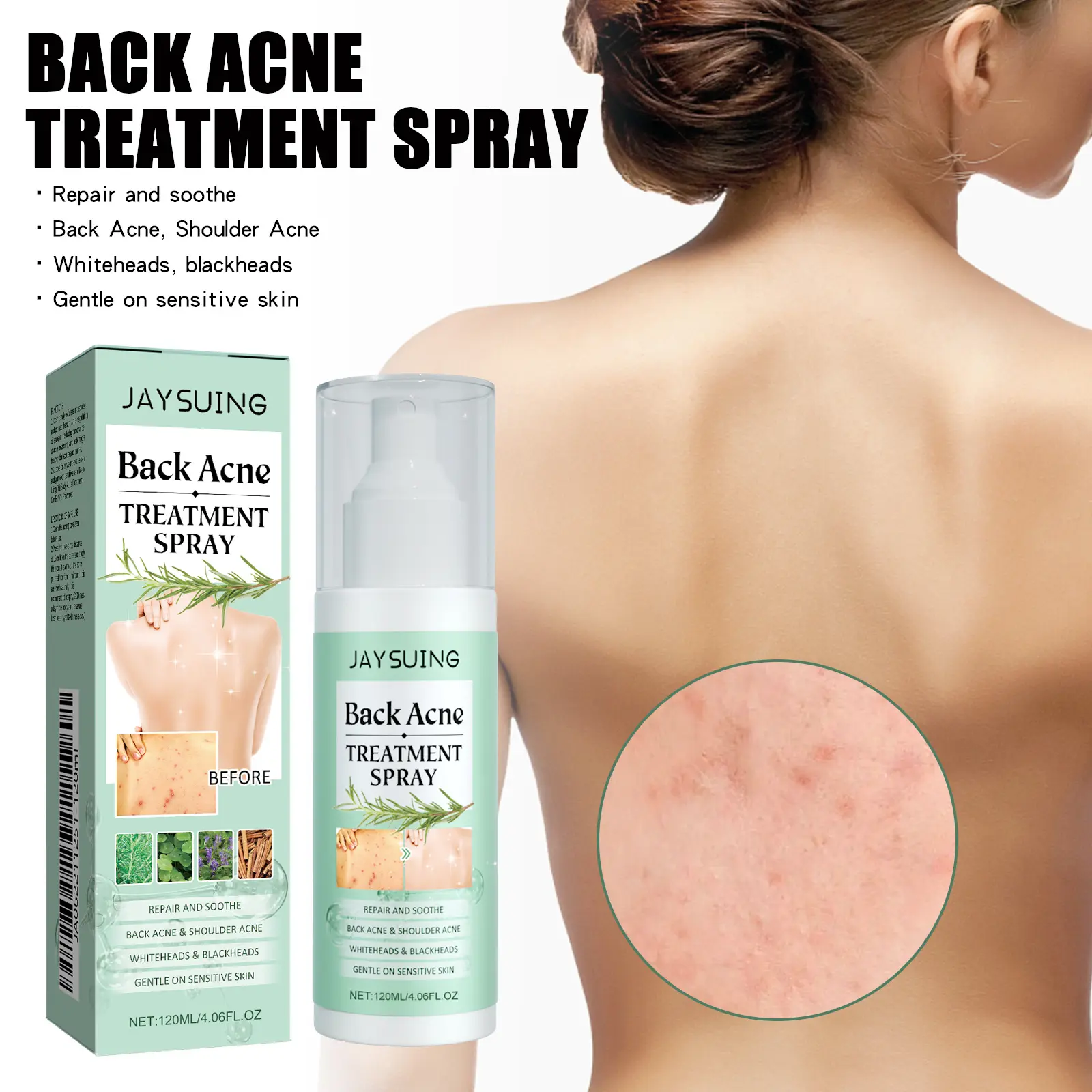 Back Acne Repair Spray, Soothes the back skin, Repair Body Acne Fade Acne Mark Skin Care Spray, Moisturizes and cleans the skin