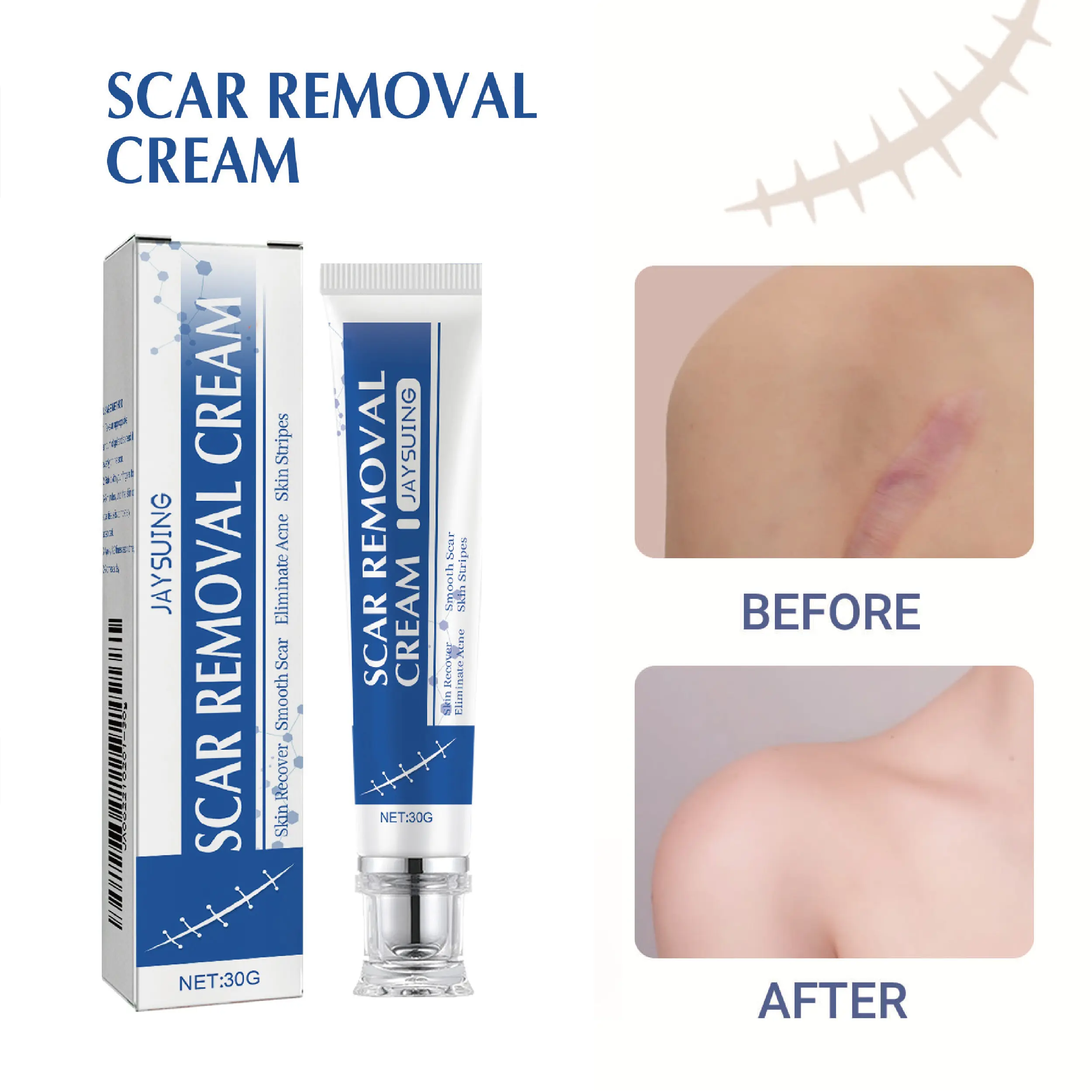 Professional Scar Removal Gel- Scarremovaltreatment for keloids, C-sectionS, surgeries,burns, acne andmore.Body care cream