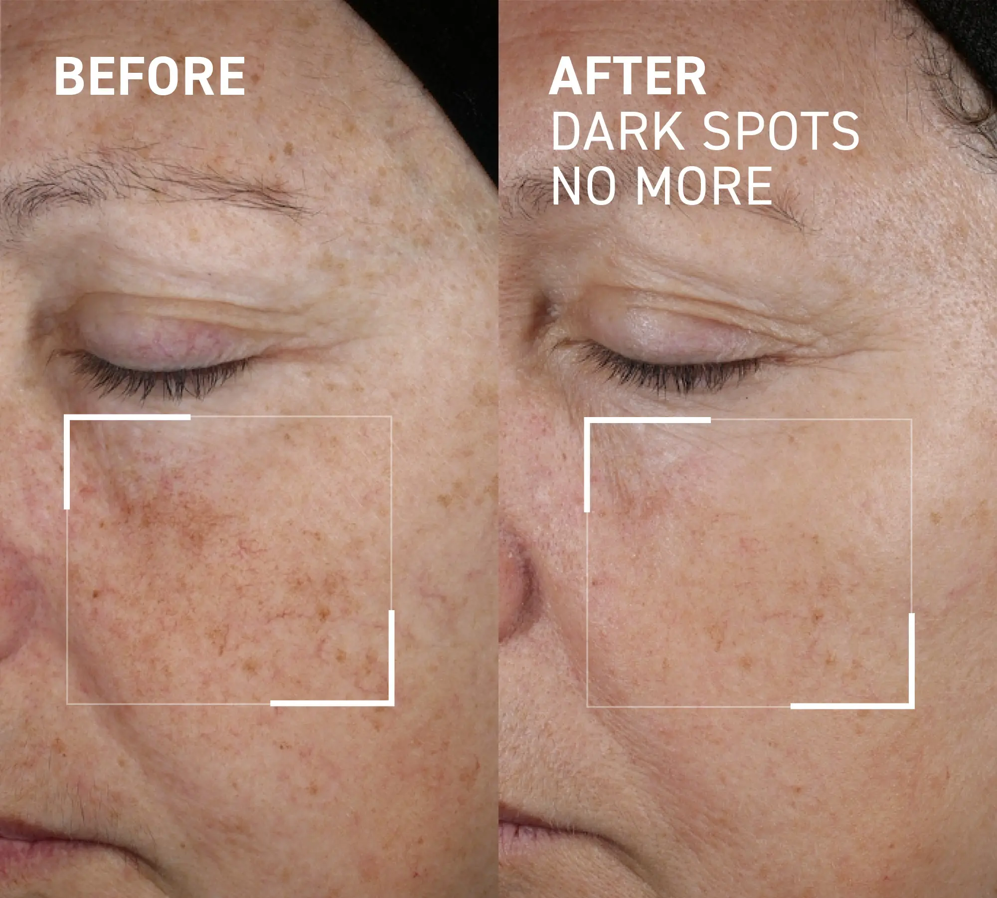 DARK SPOTS NO MORE - A triple acid spot minimizing gel that reduces number, intensity, and size of pigmented spots, brightens and evens skin tone and texture.