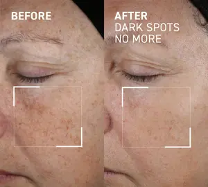 DARK SPOTS NO MORE - A triple acid spot minimizing gel that reduces number, intensity, and size of pigmented spots, brightens and evens skin tone and texture.