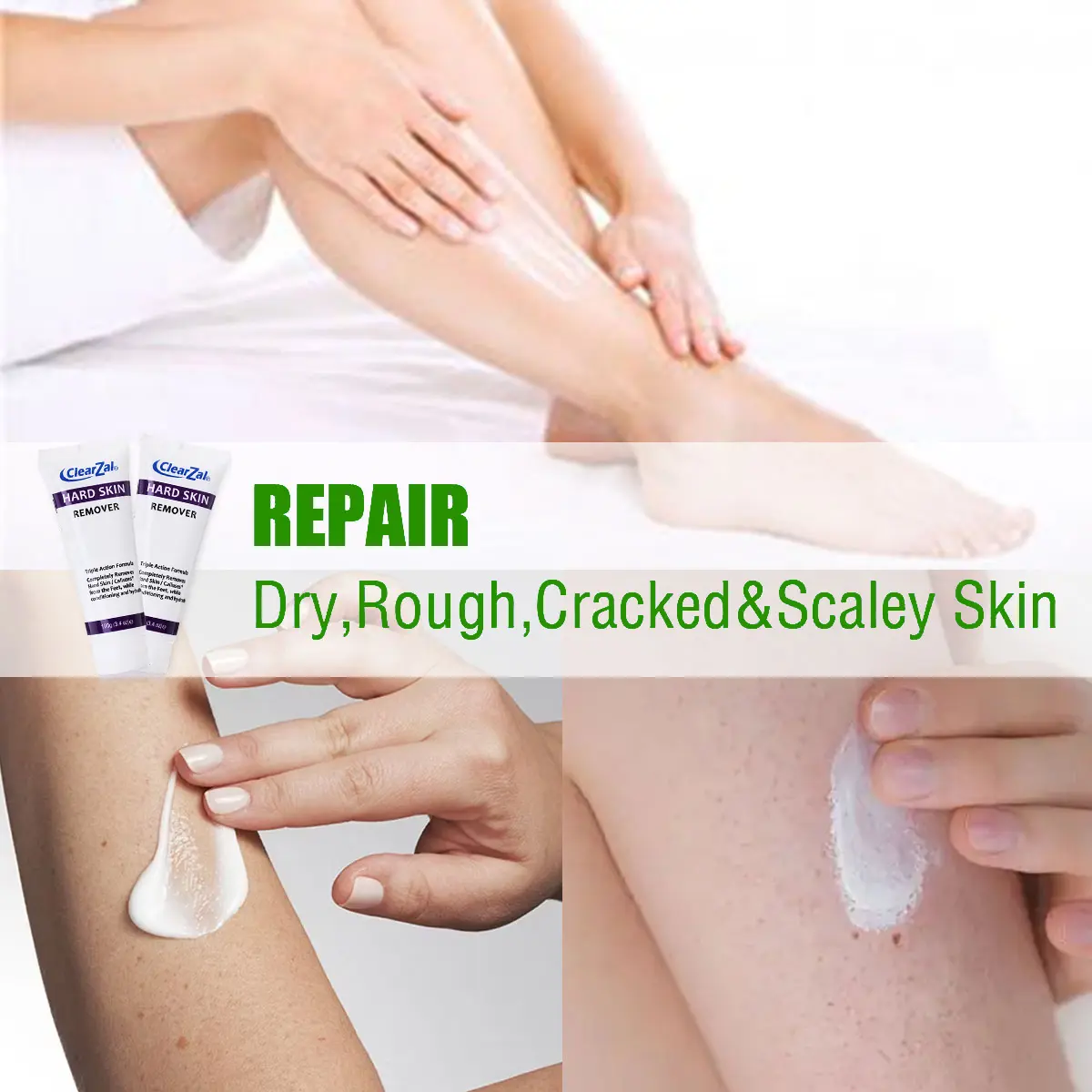 ClearZal targets chicken skin on arms and legs and enlarged pores,  improves it, and can be used all over the body Triple action formula exfoliates old skin cells 3.4 Ounce [YW]