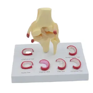 Human Knee Joint with Meniscus Tears Model