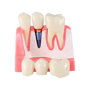 Dental Model 4 Times Dental Implant Teeth Demo Model with Removable Crown and Bridge for Teaching and Studying
