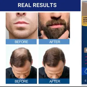 Kirkland Signature Extra Strength Minoxidil 5% Hair Regrowth Treatment for Men 60ml Unscented Foam Solution 6 Months Supply Real Results