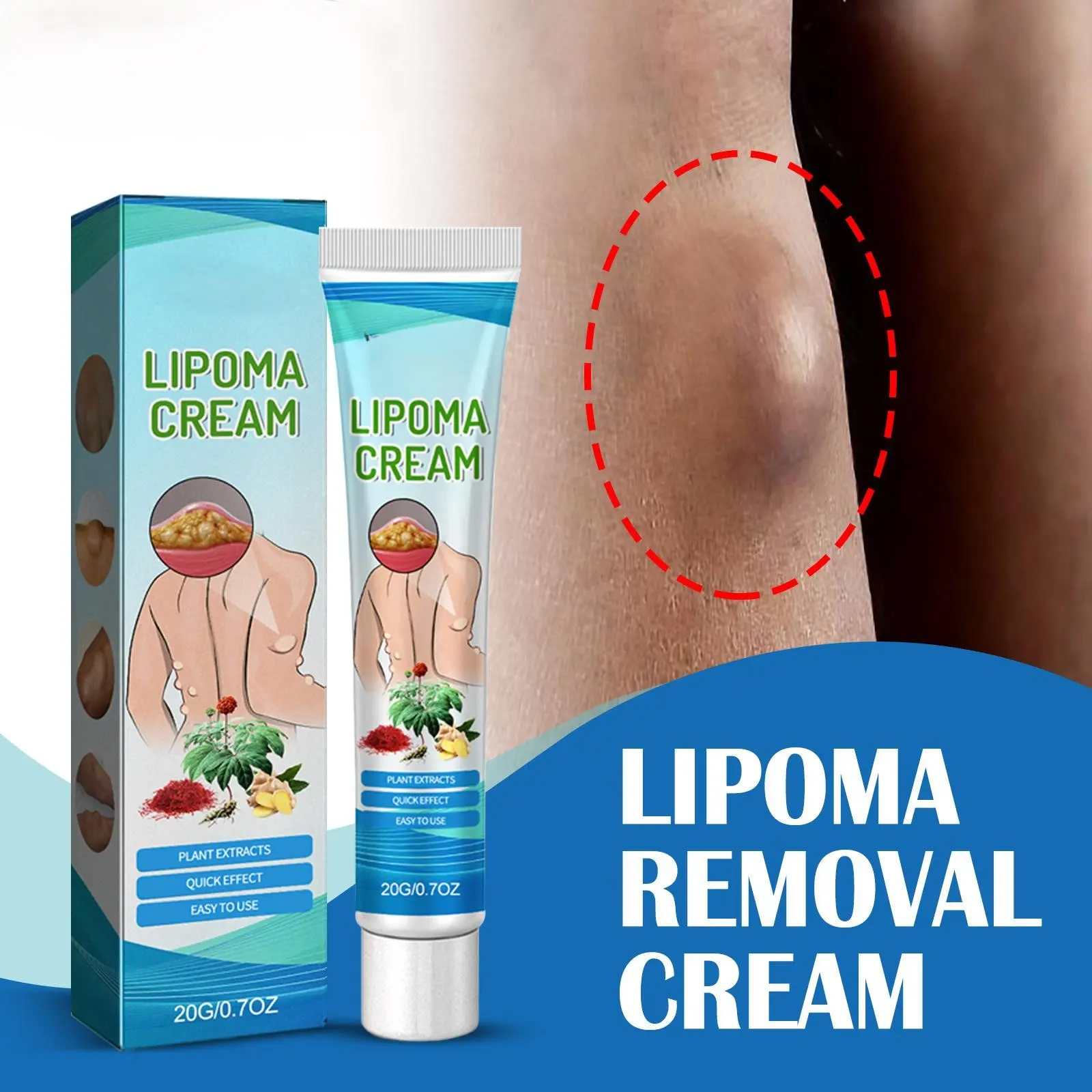 Relieve subcutaneous lumps caused by lipoma-fat cream