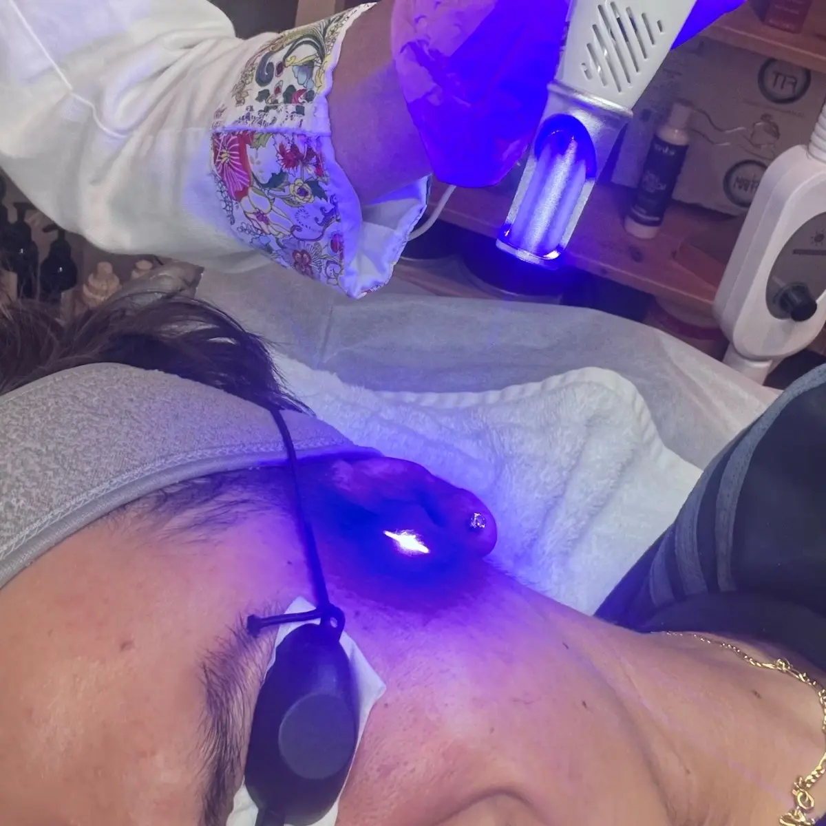 Laser no ablativo para acne