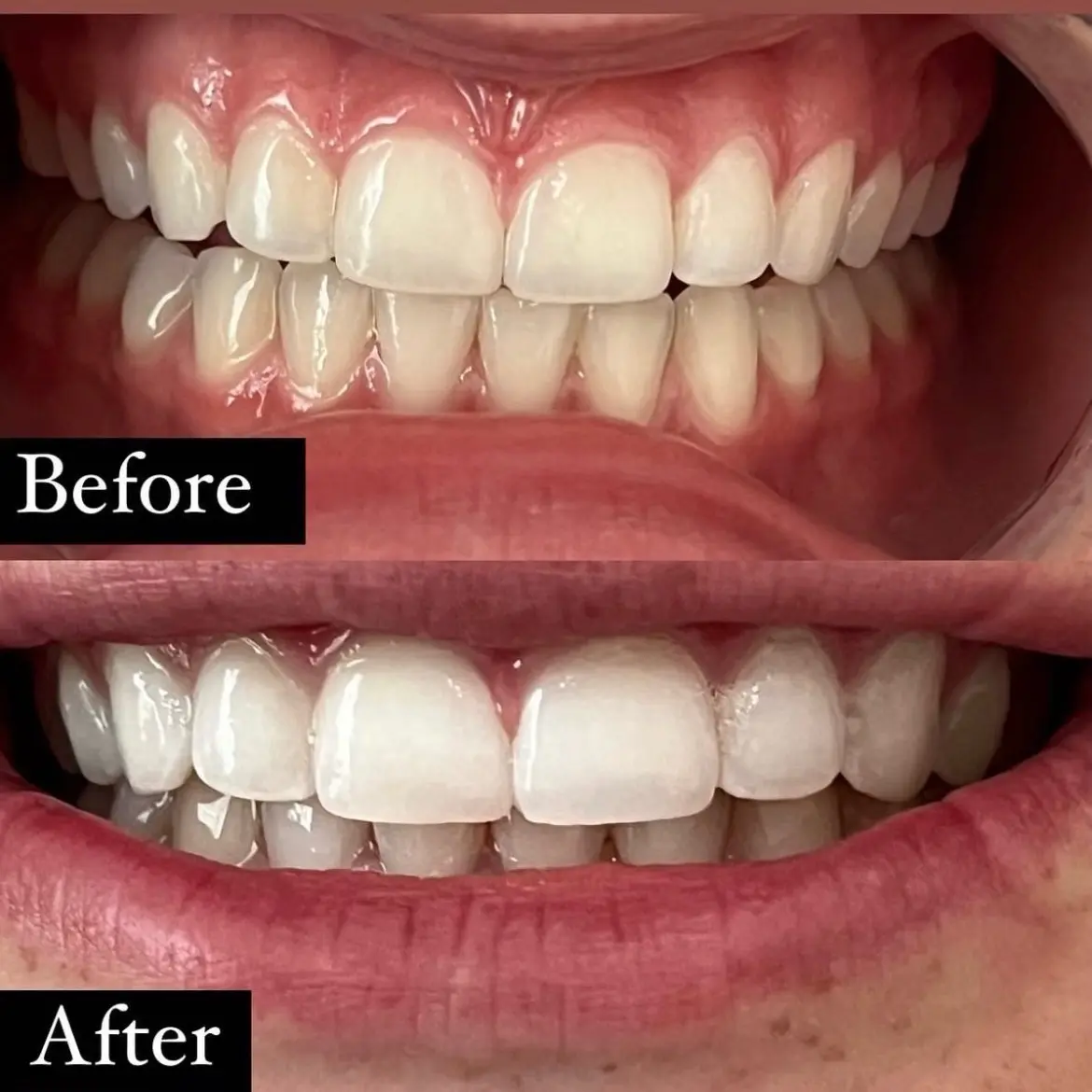 Teeth whitening pens! Instant results Teeth whitening pens! Instant results
