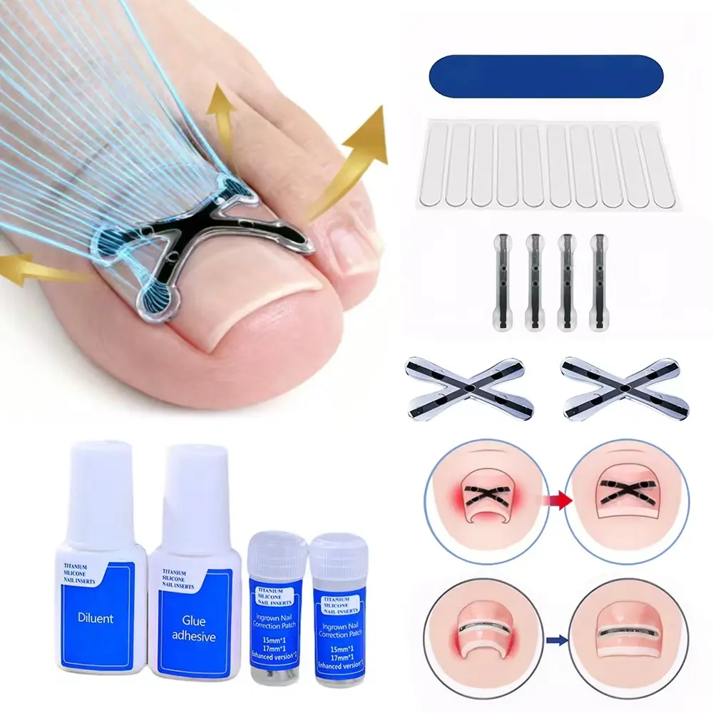 Titanium Alloy Ingrown Toenail Treatment, Quick Relief, Ingrown Toenail Removal Kit， Professional Ingrown Toenail Corrector,  All Nail Types Manicure Nail Products Cutics
