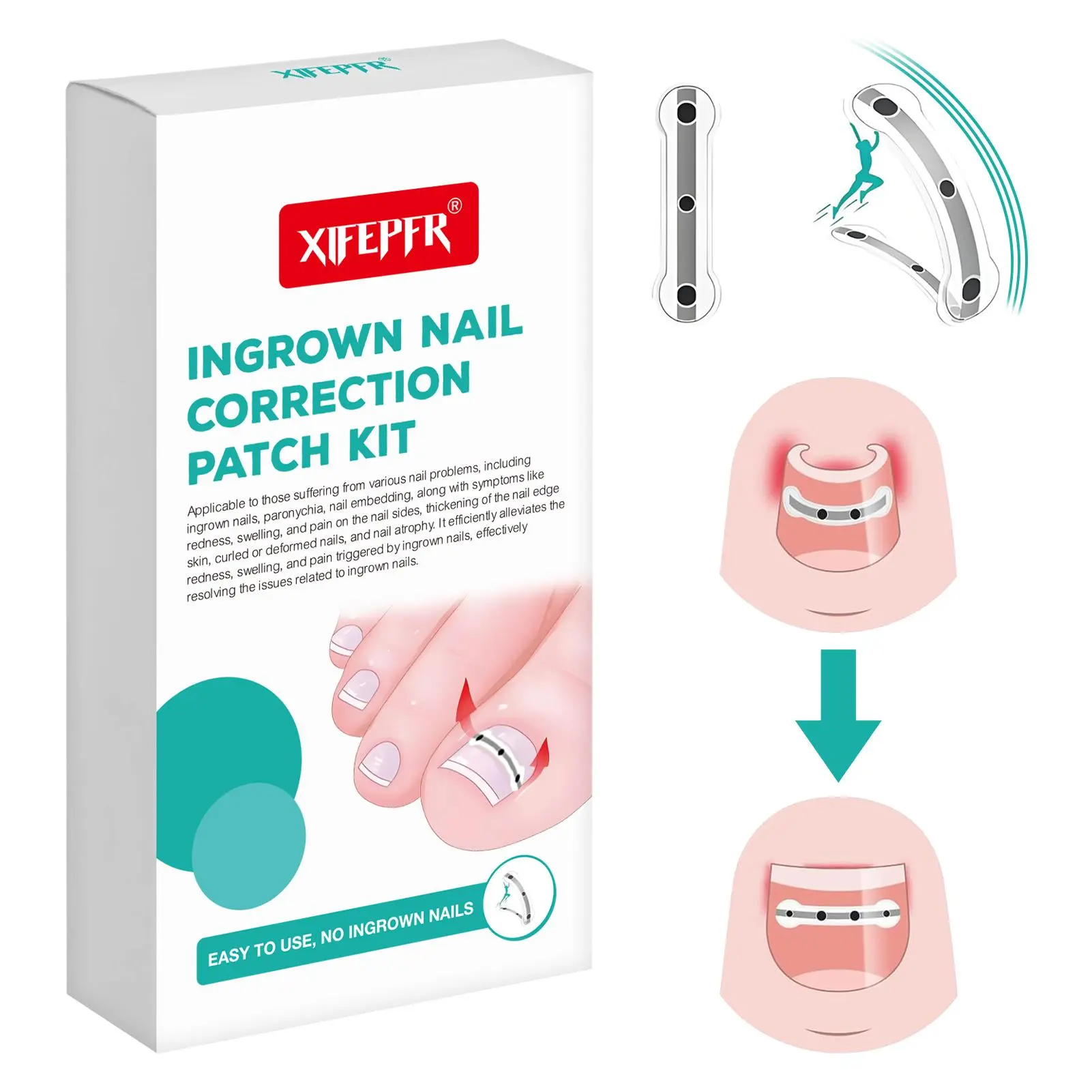 South Moon Ingrown Toenail Treatment Patch Kit, Professional Titanium Alloy Corrector for Curved Nails Repair & Pain Relief, Nail Supplies with Tools, 0.59-0.67 in, Toenail Removal, Repairing