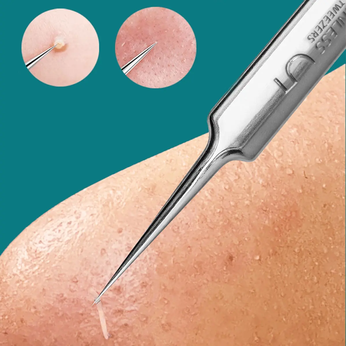 1pc Blackhead removal tool, Stainless acne extractor, double-ended comedone extractor, facial acne needle cleaning tool, Acne Clearing Products, Remove Blackhead