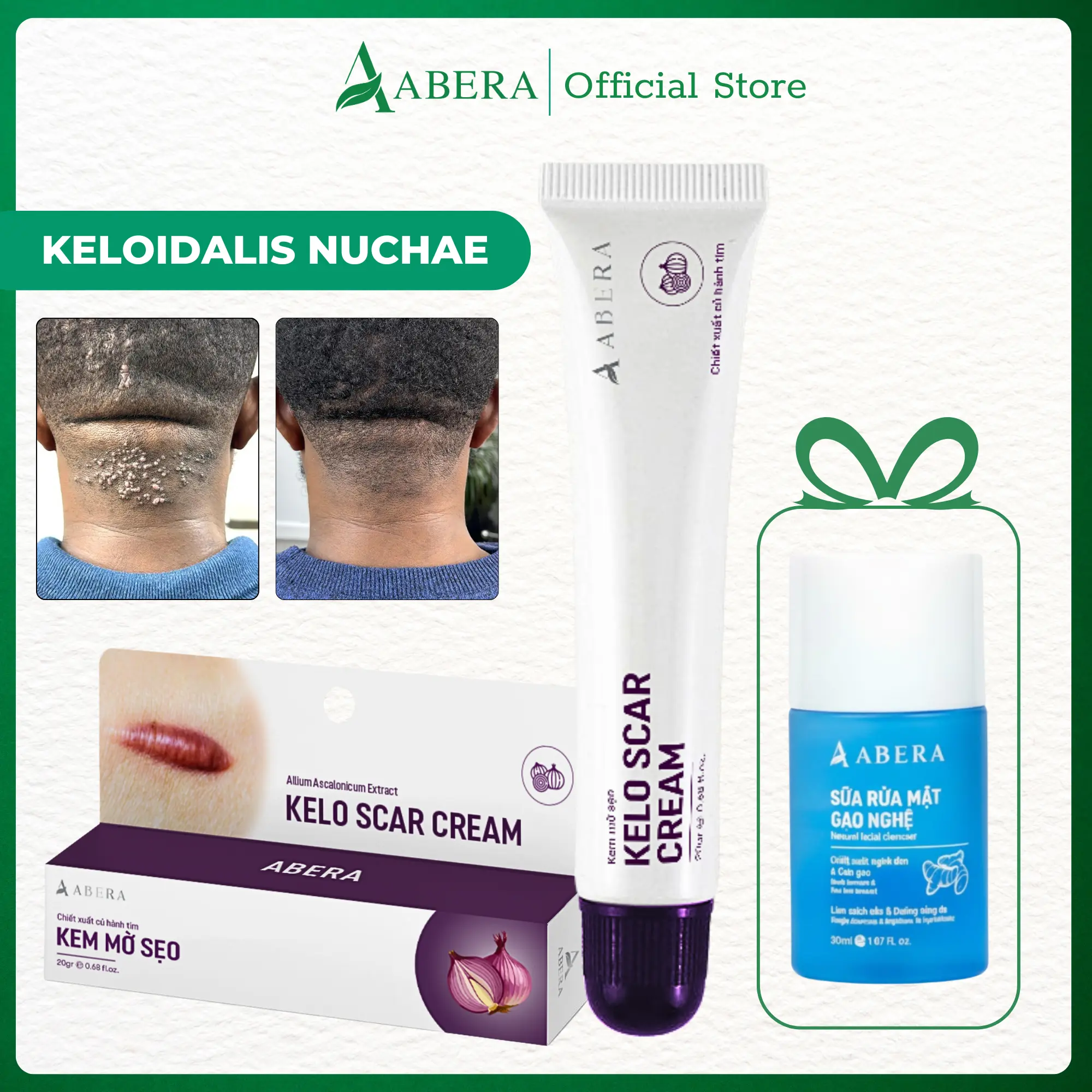 Abera Kelo Scar Cream for Acne Keloidalis Nuchae (AKN) – Scar Flattening Cream for Back of Neck Bumps, Raised Keloid Scars & Thick Neck Skin (0.7 Oz)