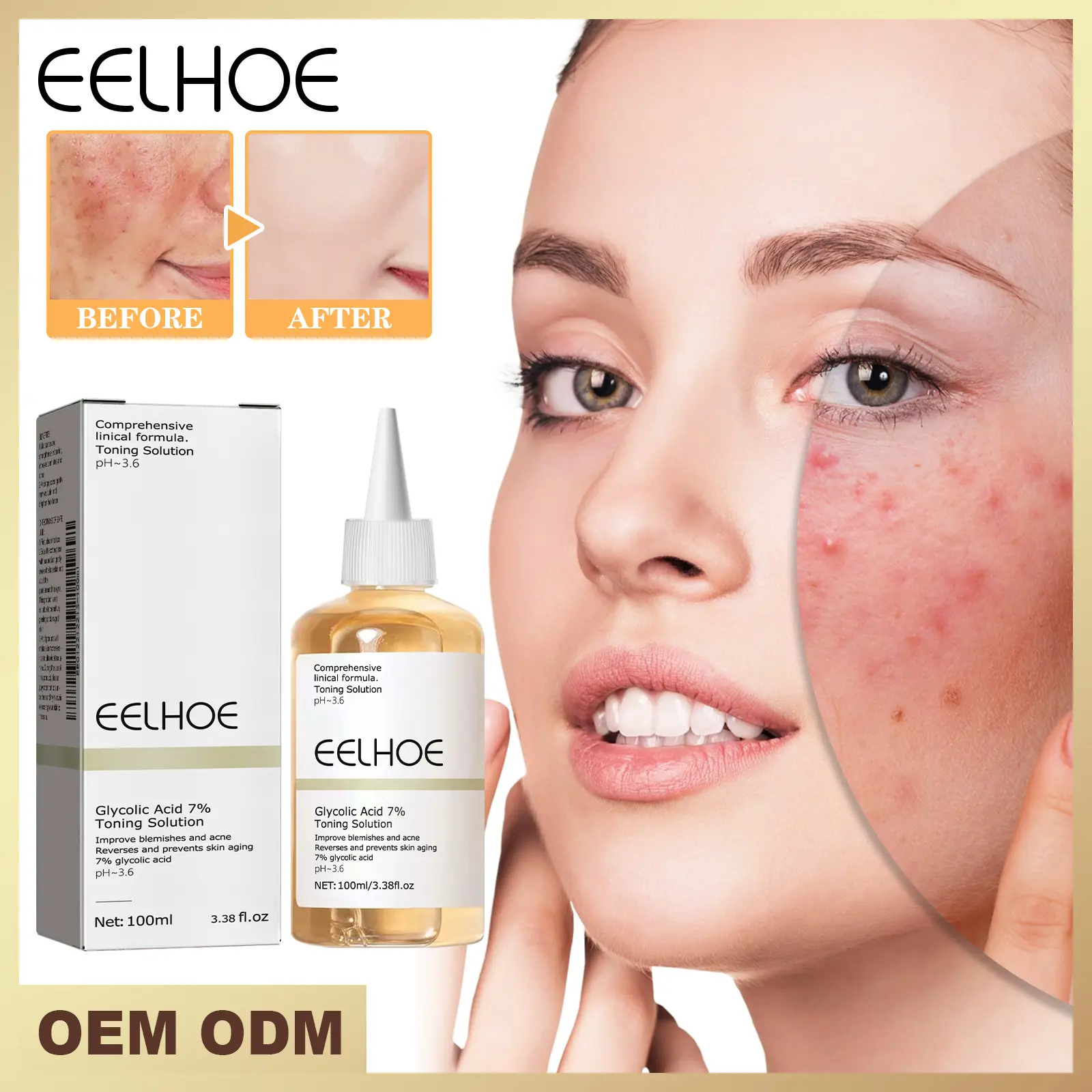 EELHOE Glycolic Acid 7% Toner for Acne Removal, Diminishing, Repairing, and Moisturizing Skin