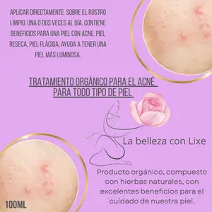 Organic Acne Toner, Gentle Skin-Clearing Formula for Blemish-Prone Skin