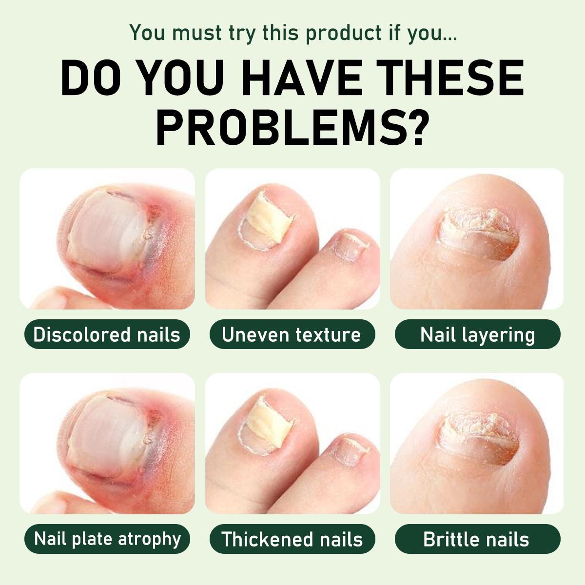 Nail Fungus Treatment, Extra Strength Nail Serum, Triple Action Formula for Damaged Nails Care & Healthy Looking Nails Nail Fungus Treatment, Extra Strength Nail Serum, Triple Action Formula for Damaged Nails Care & Healthy Looking Nails