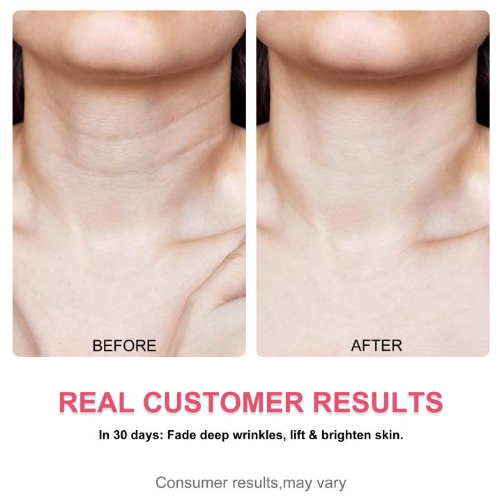 Misoour Neck Mask Set:Collagen Peptide Anti-Wrinkle Neck Mask + Astaxanthin Firming & Smoothing Serum|Reduce neck wrinkles, Moisturize and brighten,Firm and lift#TikTokShopBlackFriday