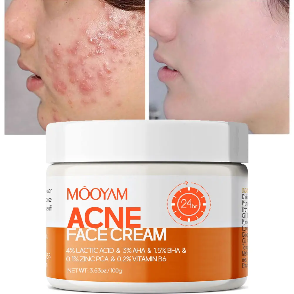 MOOYAM Acne Scar Treatment Cream 50ml Centella & Snail Repair Cream Post-Acne Marks Removal Acne&Pimple Treatment Fragrance Free Paraben Free Skincare Salicylic Skin Repair Sensitive Teens Scent free skincare Healthcare Aroma Therapeutic pimplepatches