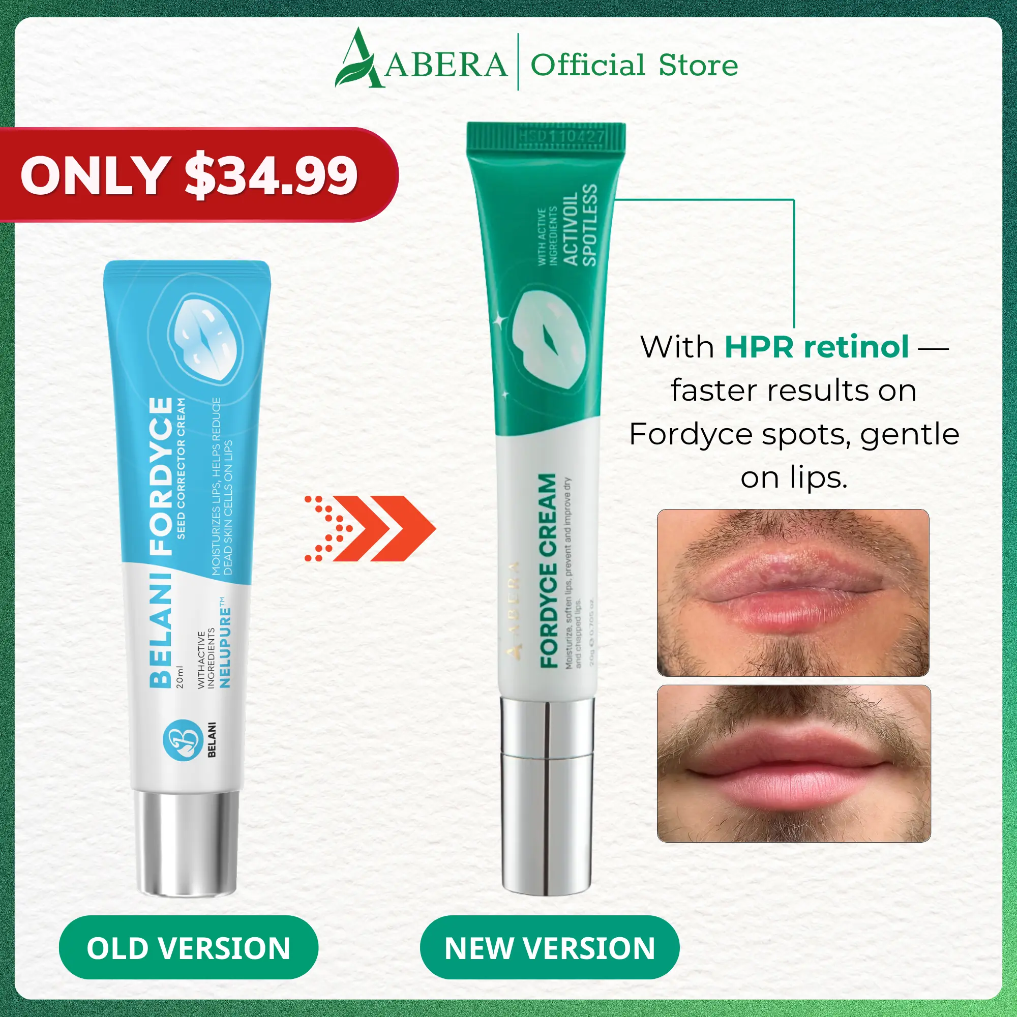 Abera Fordyce Cream - Fordyce Spot Care, Lip Moisturizer & Repair Balm for Men, Helps Improve Dark Lips, Enriched with  HPR & Activoil Spotless, 0.7 Oz (0.7 Oz)