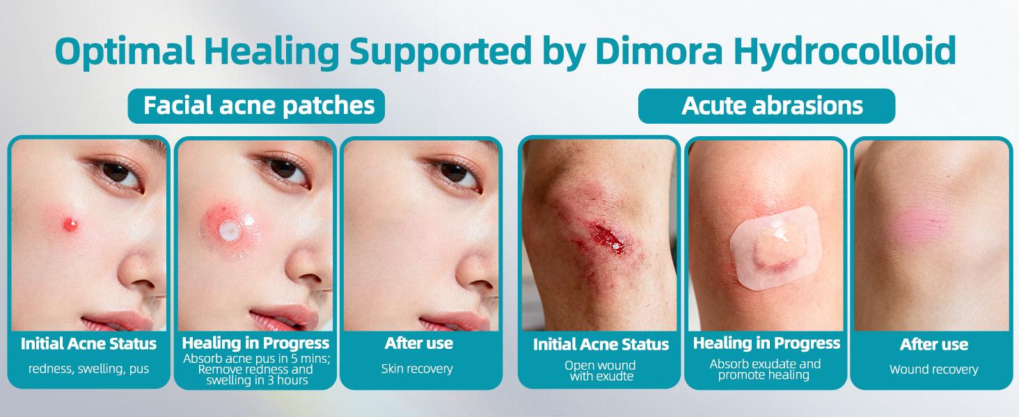 (HSA/FSA Eligible) Dimora Medical-Grade Hydrocolloid Acne Patch Roll, Cuttable Overnight Pimple Patches, Large Roll (2 in x 16 ft), for Acne, Open Wounds & Facial Oil Absorption, hydrocolloid bandages, Pimple Extraction, Face Care Products, SohoChic (HSA/FSA Eligible) Dimora Medical-Grade Hydrocolloid Acne Patch Roll, Cuttable Overnight Pimple Patches, Large Roll (2 in x 16 ft), for Acne, Open Wounds & Facial Oil Absorption, hydrocolloid bandages, Pimple Extraction, Face Care Products, SohoChic