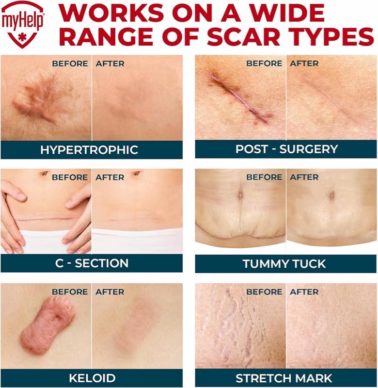 Medical Grade Silicone Scar Tape - 1.6”x150” - Visible Difference on Keloid &...