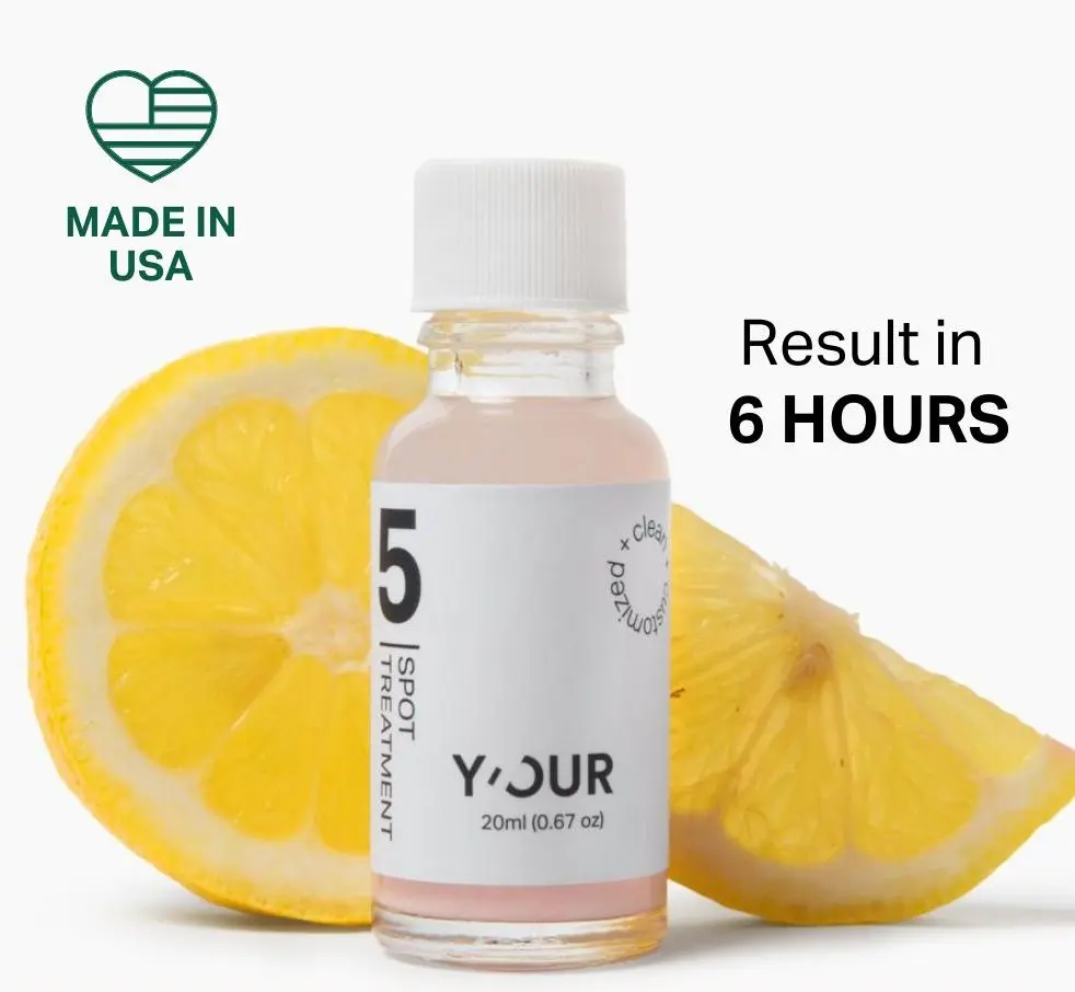 Acne Drying Spot Treatment by Y'OUR, with Salicylic Acid & Bentonite Clay for Sensitive Skin 20ml Fast Acting Potent Pimple Remover, Made in USA. Valentine gift for her Acne Cream Blemish Patches