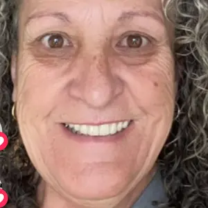 SKINN Cosmetics DermAppeal Microdermabrasion BeautyTreatment w/ V5 Crystal Technology Facial Exfoliate Tube - Powerful Microdermabrasion Skincare Treatment for All Skin Types Brightening Exfoliating Moisturizing Chemical Exfoliant