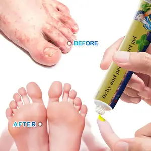 Applying gel to the feet can alleviate itching on the sole, peeling between the toes, fungal infections, and foot ulcers athlete's foot cream antifungal