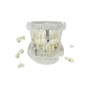 Transparent Implant Teeth Model, Transparent Dental Implant Disease Teeth Model Dentist Standard Removable Tooth Pathological Teaching Model