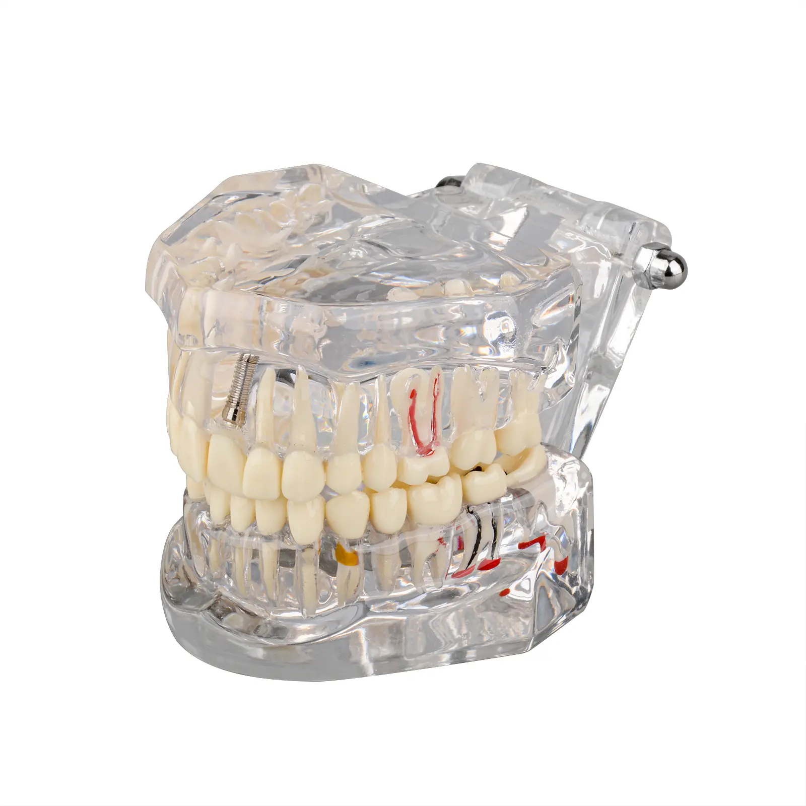 Transparent Pathological Teeth Model with Dental Implant Bridge Dental Teaching Model for Patients and Dental Students Oral