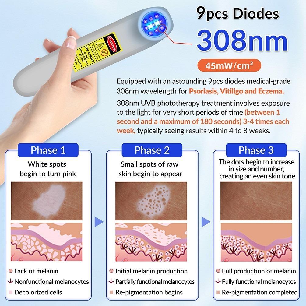 ZJZK 9 Diodes 308nm UVB Excimer Phototherapy Device, 55mW/cm² High Energy Density, Handheld Blue Light Skin Treatment, Targeted Therapy for Vitiligo, Psoriasis, Eczema, Atopic Dermatitis, Portable Home Use for Skin Disorders