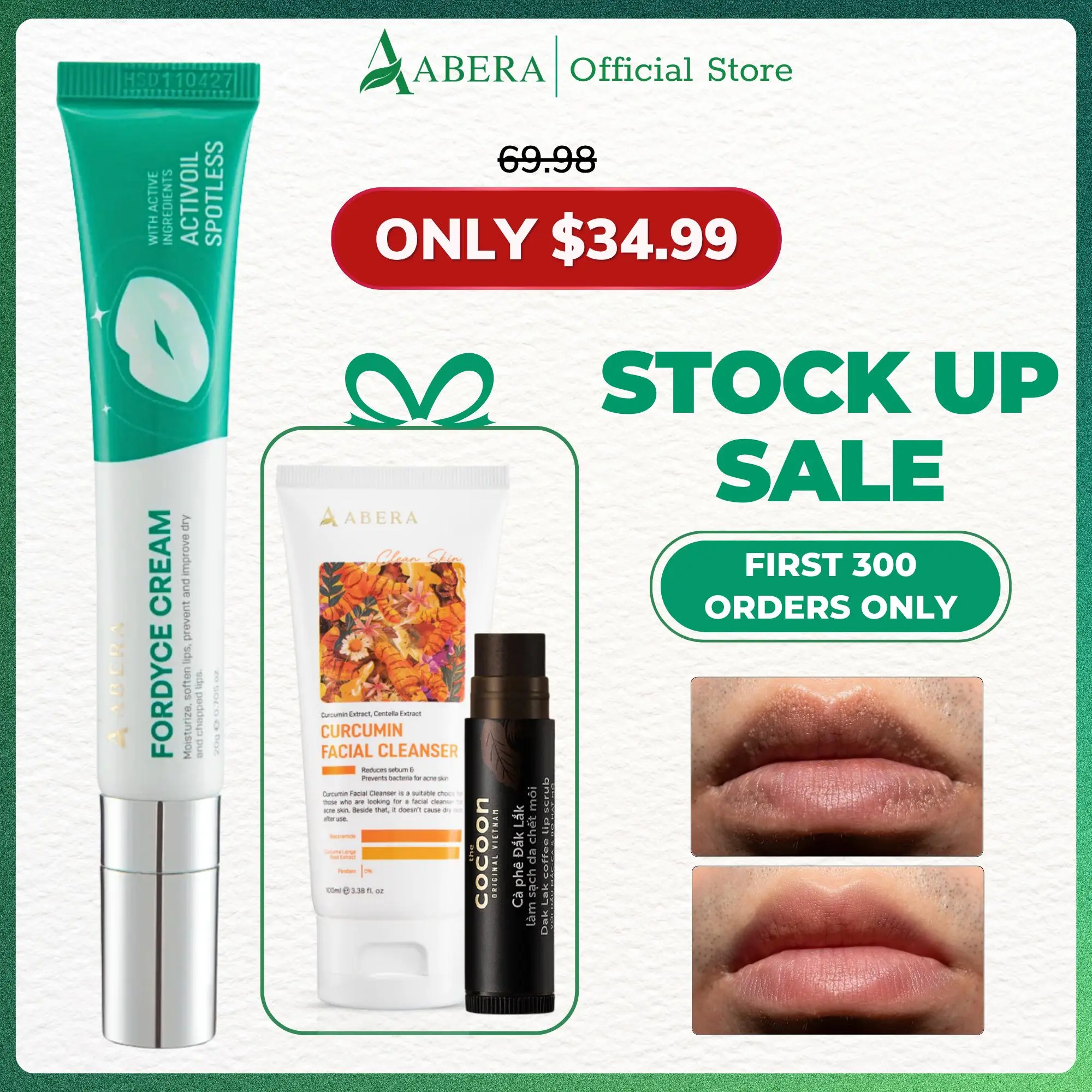 Abera Fordyce Cream - Reduce Fordyce Spots on Lips, Return Rosy, Smooth Lips - 20ml