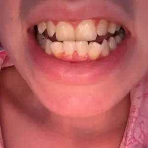 Product Review of GuruNanda Whitening Strips, 7-day treatment (7 Packets - 2 Strips per pack) - Non-Slip, Dry Strip Technology from L**i