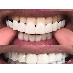 Comfortable Daily Dental Alignment Tool Removable Teeth Cleaning Whitening Braces Silicone Design Convenient Correction Tool