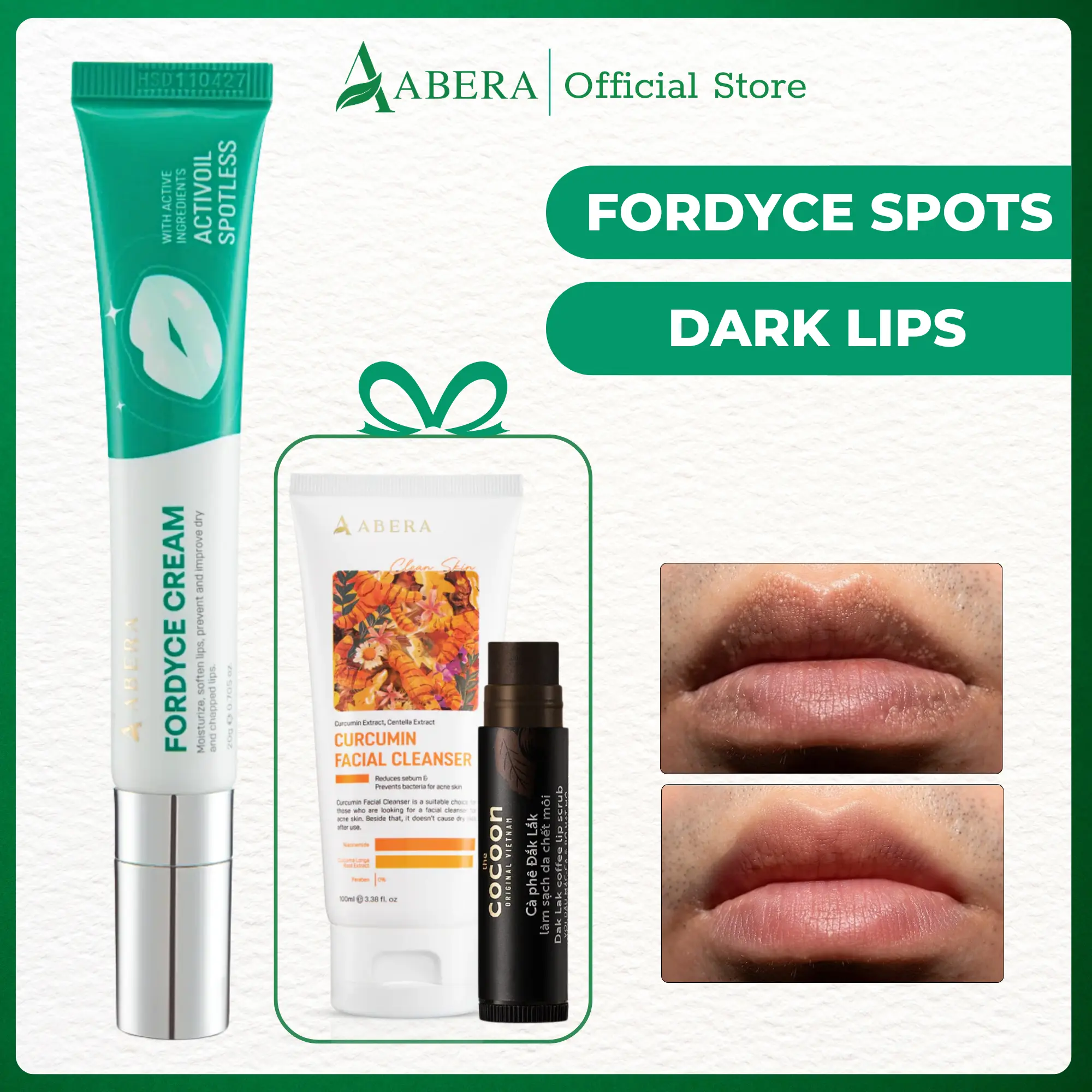 Abera Fordyce Cream – Fordyce Spot Care, Lip Moisturizer & Repair Balm for Men, Helps Improve Dark Lips, Enriched with Shea Butter & HPR – Next Gen Retinoid (0.7 Oz)