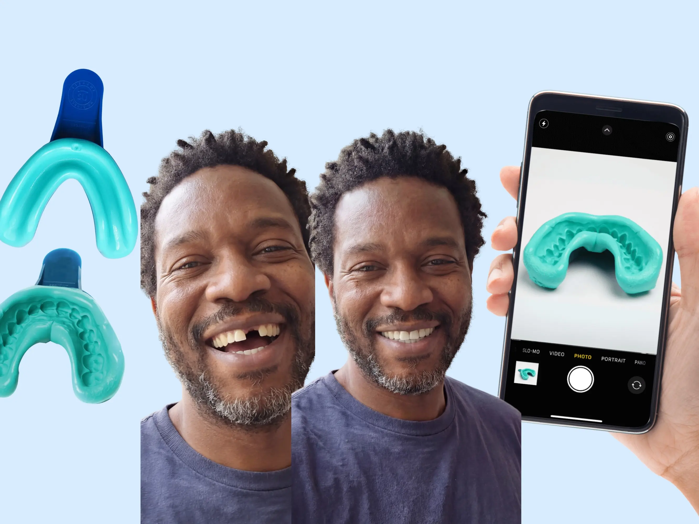 Klyros Custom removable Tooth Appliance - For upper or lower missing teeth, professionally made, custom fit to your mouth