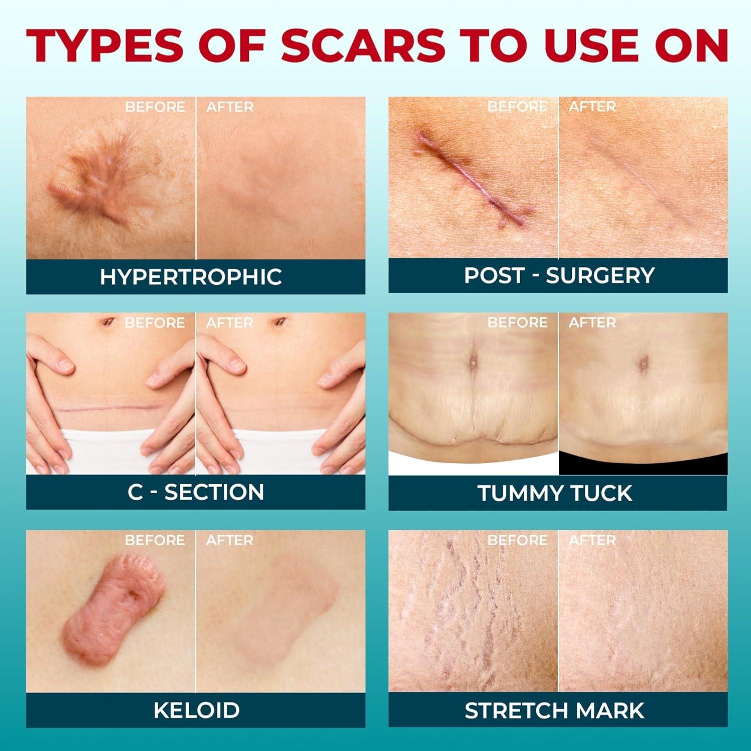 Silicone Scar Sheets(1.6"X 59" Roll-1.5M), Silicone Scar Repair Cream, Silicone Scar Tape, Silicone Scar Strips, Professional Scar Removal Sheets for C-Section, Acne, Buruns & Keloids, Suitable for All Skin Tayes