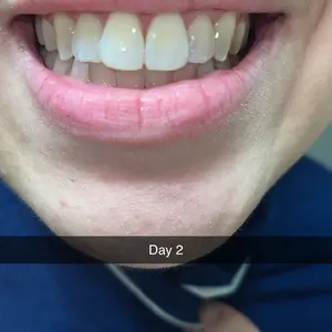 Product Review of GuruNanda Whitening Strips, 7-day treatment (7 Packets - 2 Strips per pack) - Non-Slip, Dry Strip Technology from O**s ♣**