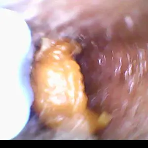 Earwax Removal Tool - Effective Solution for Clogged Earwax - Ideal for All Ages
