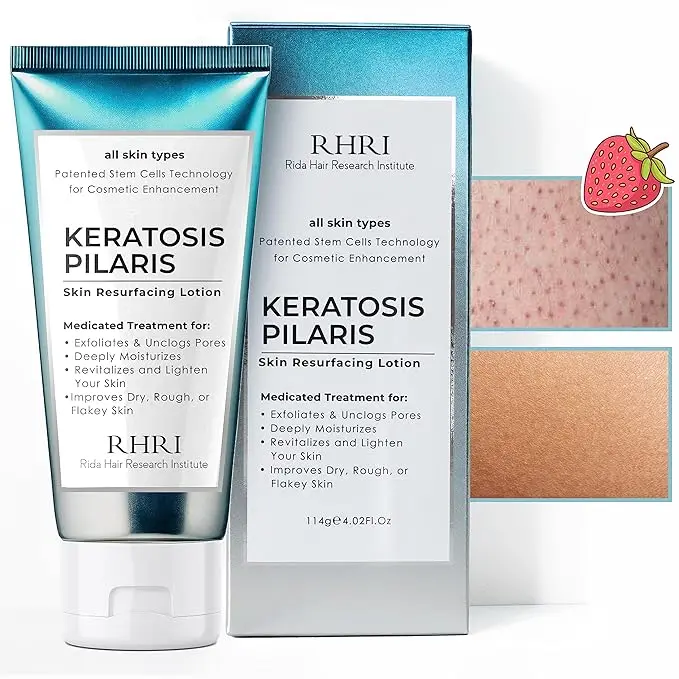 Keratosis Pilaris Treatment | Keratosis Pilaris Lotion with 10% AHA | Gentle Exfoliation For Strawberry Legs, KP & Ingrown Hairs | Smooth & Hydrating Body Lotion For Redness, Dry, Rough And Flaky Skin
