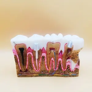Dental Cavity Model, Tooth Decay Mold, Pathological Evolution Process, Medical Education Display, Patient Teaching Aid, Dental Mold Showcase