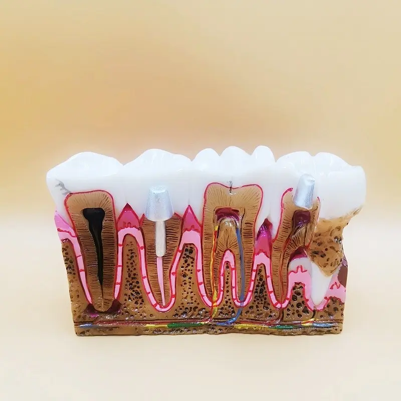 Dental Cavity Model, Tooth Decay Mold, Pathological Evolution Process, Medical Education Display, Patient Teaching Aid, Dental Mold Showcase, Oral
