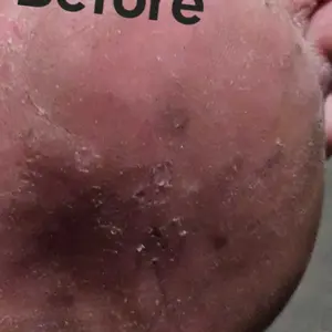 Vamy Antifungal Foot Spray with Tea Tree Oil & Oregano Leaf – 3.38 fl oz (100ml) | Clinically Tested for Athlete’s Foot (Tinea Pedis) | Stops Itching, Fights Odor & Fungus | Long-Lasting Protection Gentle