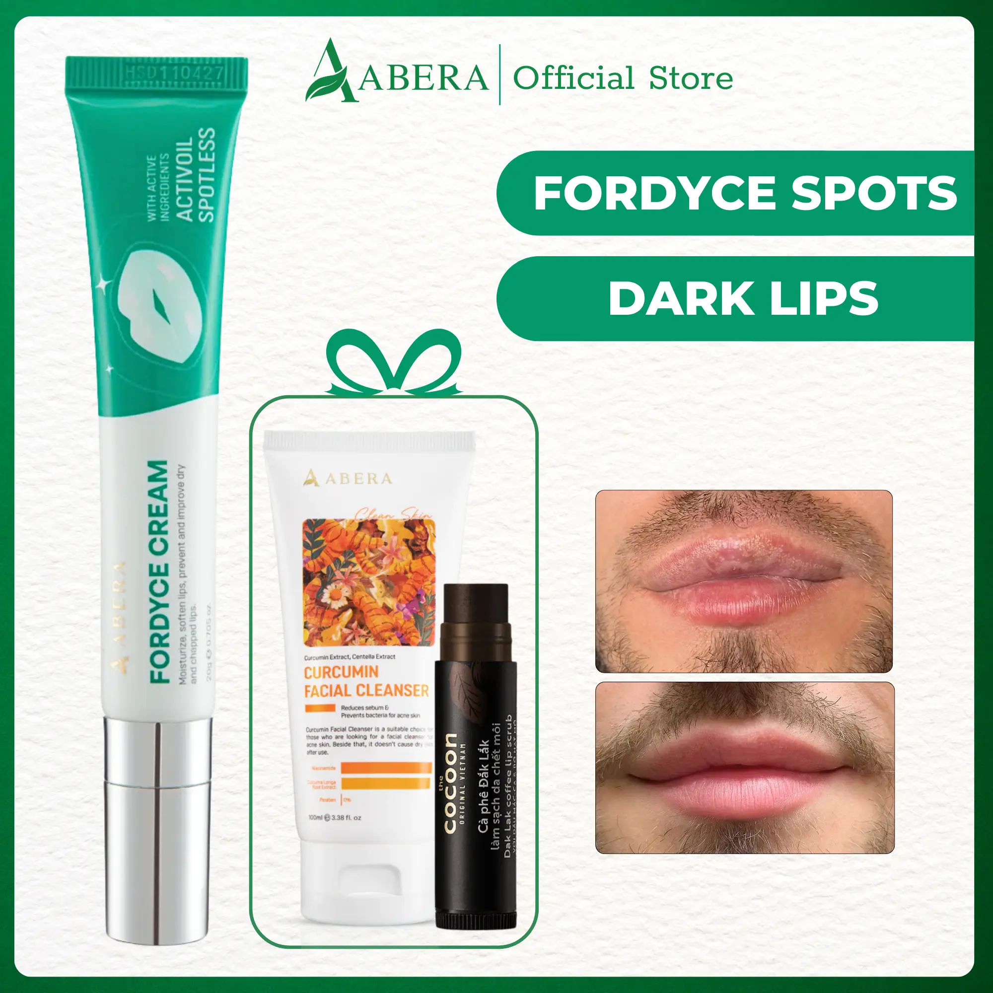 Abera Fordyce Cream for Lips – Fordyce Spot Care, Lip Moisturizer & Repair Balm for Men, Helps Improve Dark Lips, Enriched with Nelupure & Shea Butter (0.7 Oz)