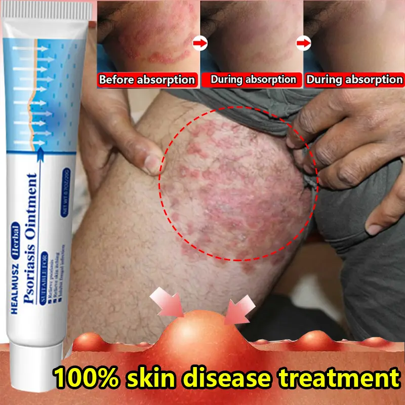 Antifungal & Psoriasis Cream – 100% Natural Plant Formula for Psoriasis, Tinea (Scalp, Body, Groin, Versicolor), Copper Fungus. Fast Relief for Itching, Dryness, Redness. Deep Hydration, Soothing & Non-Recurring– 20g